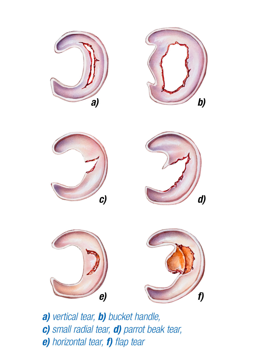 meniscal-tear-types